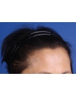 After Hair Transplant&nbsp;Hair Thinning